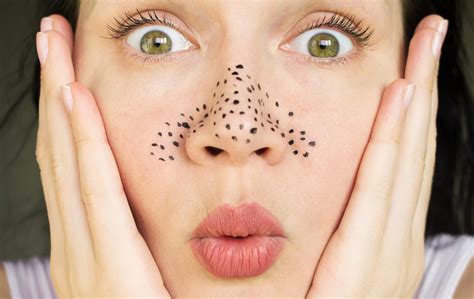 Unbelievable Blackhead Removal 2024: What The Experts Are Saying About This Viral Trend Image 15