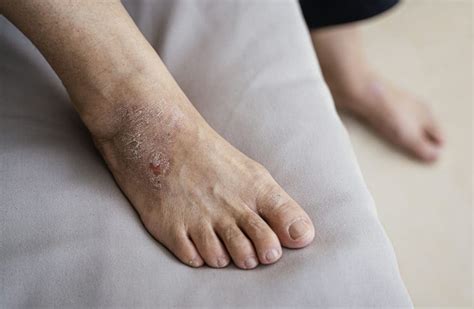 5 Reasons Why Your Feet Are Peeling - Feet First Clinic