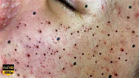 Unbelievable Blackhead Removal 2024: The Year's Biggest Breakthrough - rjokzhf