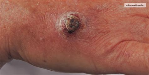 Squamous Cell Cancer: Causes, Symptoms, and Treatment