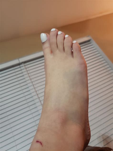 I broke my foot 😭 | Scrolller