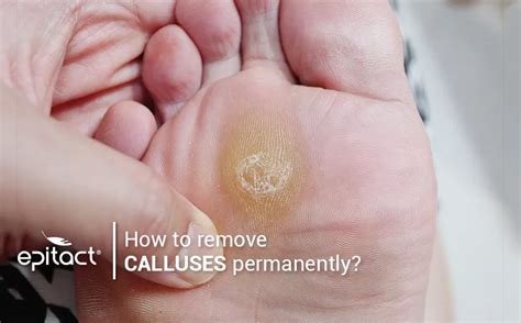 how to get rid of foot callus