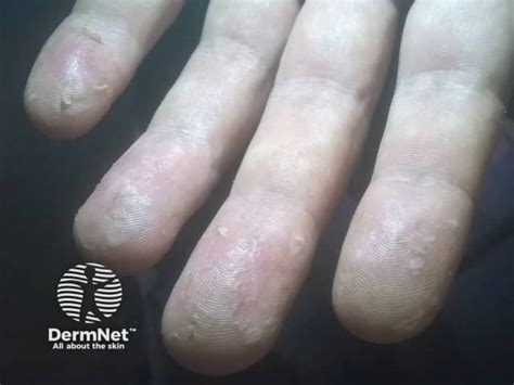 exfoliative keratolysis image