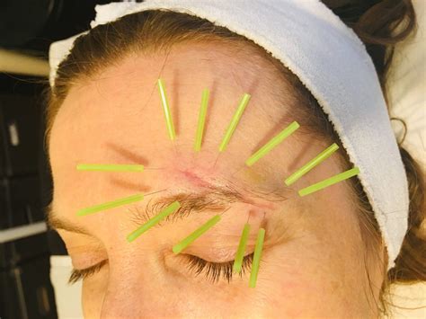 What I Learnt The Hard Way About Facial Scar Treatment - Magnificent