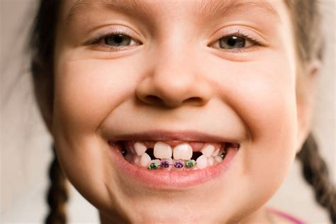 Should My Child Get Braces? | Children's Dental Center