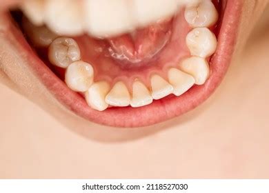 teeth   images pictures shutterstock