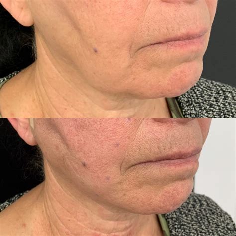 surgical face lift  jowls  chantay mccormick blog
