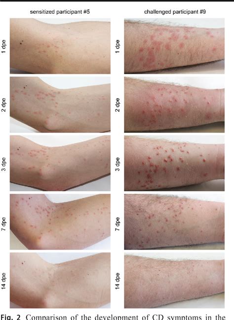 Figure 8 from Cercarial dermatitis: a systematic follow-up study of ...