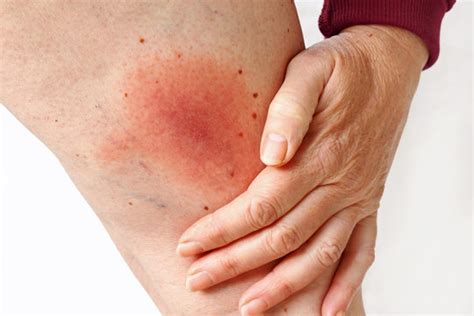 Lyme-Borreliose Images – Browse 114 Stock Photos, Vectors, and Video ...