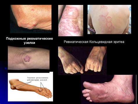 Миокардиты. Этиология - презентация онлайн
