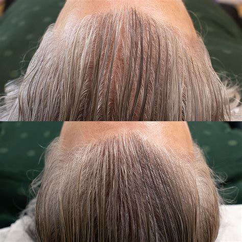 Hyper-realistic Scalp Micropigmentation Toronto - NuTatu.com