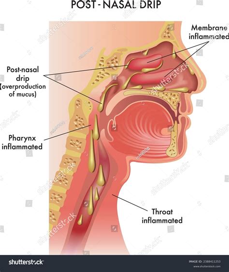 Mucus Stuck In Throat
