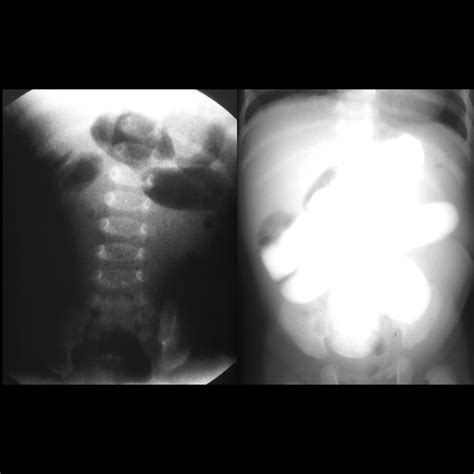 Pediatric Abdominal Adhesions | Pediatric Radiology Reference Article