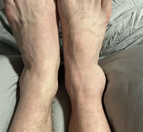 Rolled ankle : r/medical_advice