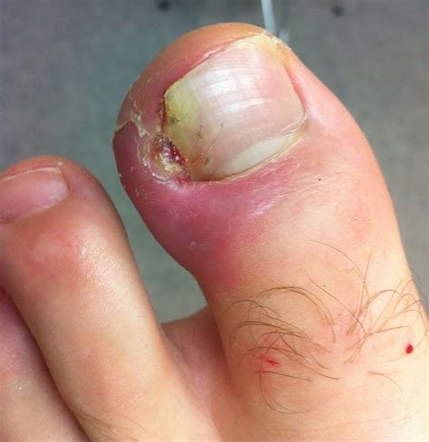 Why Is My Toenail Growing Inward at Shaun Henderson blog