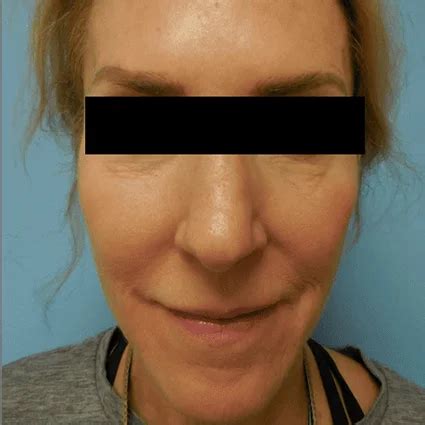 Nose Reshaping Patient #2 - Iliana Sweis, MD, FACS - North Shore Center for Plastic Surgery