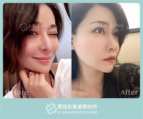 【隆鼻重修】二次隆鼻失敗變歪鼻，許英哲醫師隆鼻重修案例心得 - 萊佳形象美學診所 - 台北 新竹 台中 高雄
