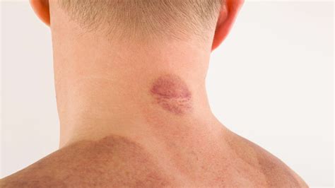 How To Remove A Hickey With Toothpaste? 4 More Natural Ways - Power