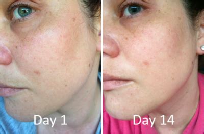 lactic acid peel