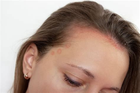 Atopijski dermatitis na lasišču - Marivelle