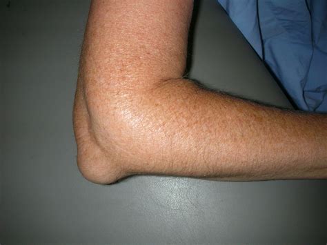 What Causes Fluid Lump On Elbow at Christopher Shirley blog
