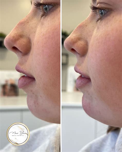 The New - Chin filler, also known as chin augmentation, is a non