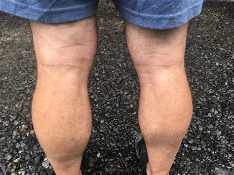 Baker's Cyst Anatomy at Sam Jimenez blog