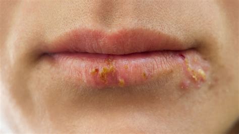 canker sore cold sore    md