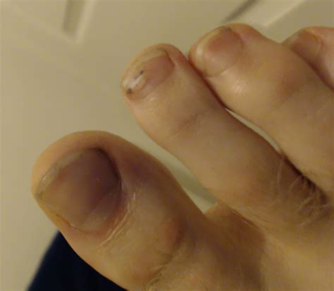 My toenail has a toenail : r/mildlyinteresting