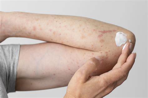 Sifilis Tem Cura Quanto Tempo - Sífilis tem cura? Veja como tratar