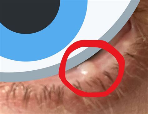 Eyelid bump. What could it be : r/DiagnoseMe