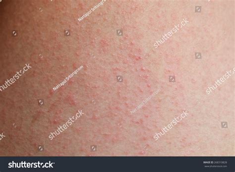 Allergic Rash Dermatitis Skin Patient Stock Photo 268310828 | Shutterstock