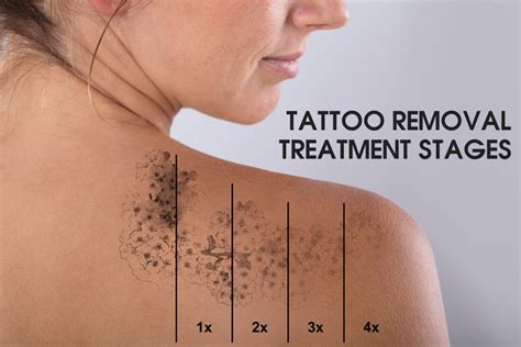 Tattoo Removal Laser Treatment in Malaysia