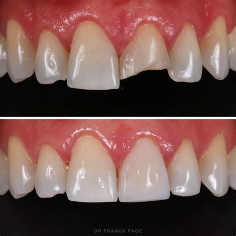 Esthetic Restoration