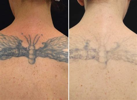 tattoo removal skin doctor clinics