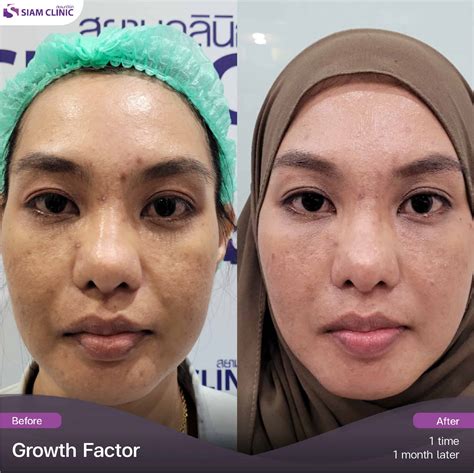 Growth Factor Therapy - Siam Clinic - Aesthetic & Wellness Clinic in Phuket