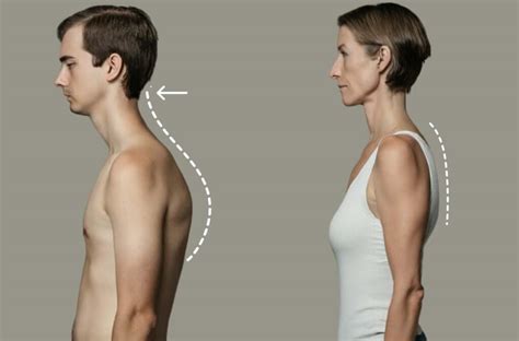 fix  head posture  exercises permanent solutions