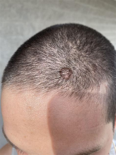 A Helpful Guide To Identifying Spitting Stitches During The Healing Process After Your Recent Major Medical Procedure