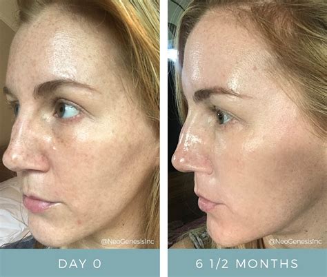 hyperpigmentation skin care product