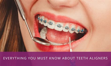 dental teeth aligners  fernando ward blog