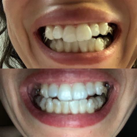 How to Fix a Crossbite – A Guide to Causes, Treatments, and Prevention – Nedho.com