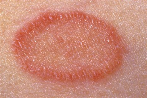 O Que É Pitiriase Rosea - Pitiriase Rosea e Psoriase o que você precisa saber - MedicineMe