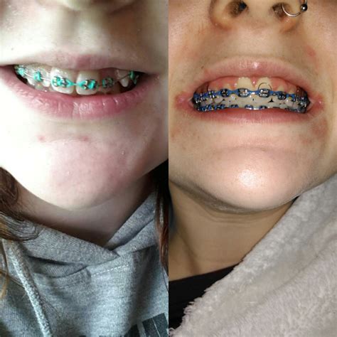 Getting my braces off soon, this is a quick before and after :) : braces