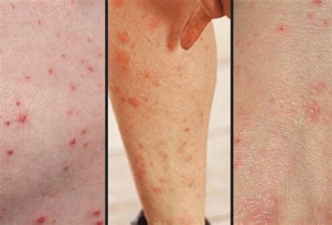 medicine details   scabies rash treatment symptoms
