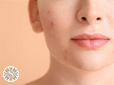 What is Acne? | Our Skin Expert Guide | Skin Clinic