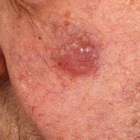 Primary cutaneous follicular lymphoma Images - Altmeyers Encyclopedia ...