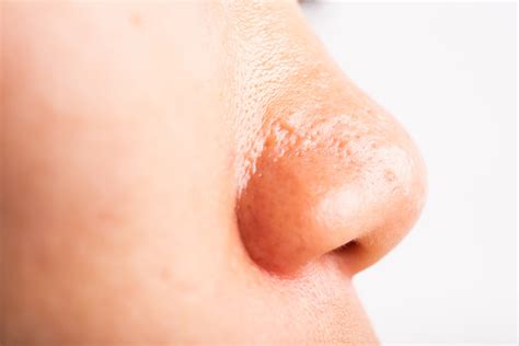 woman large pores  freckles cheek oily acne pimple  nose stock