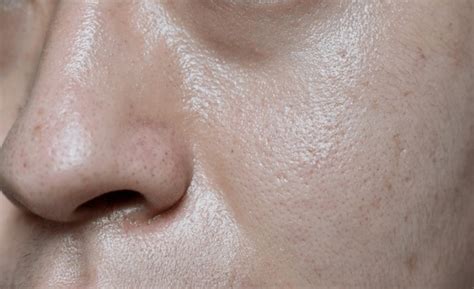Damage On Face Skin Male Royalty-Free Images, Stock Photos & Pictures ...
