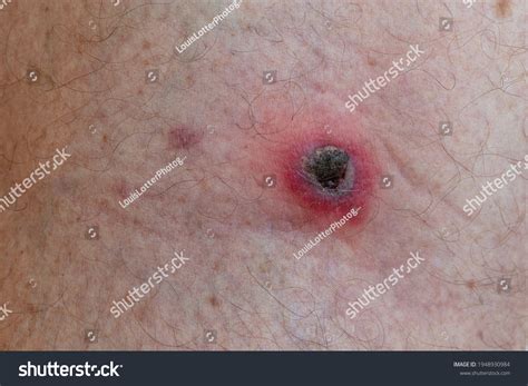 queensland tick typhus  images   images vectorielles de