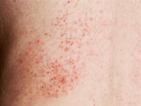 signs  skin   stoma    sm health care